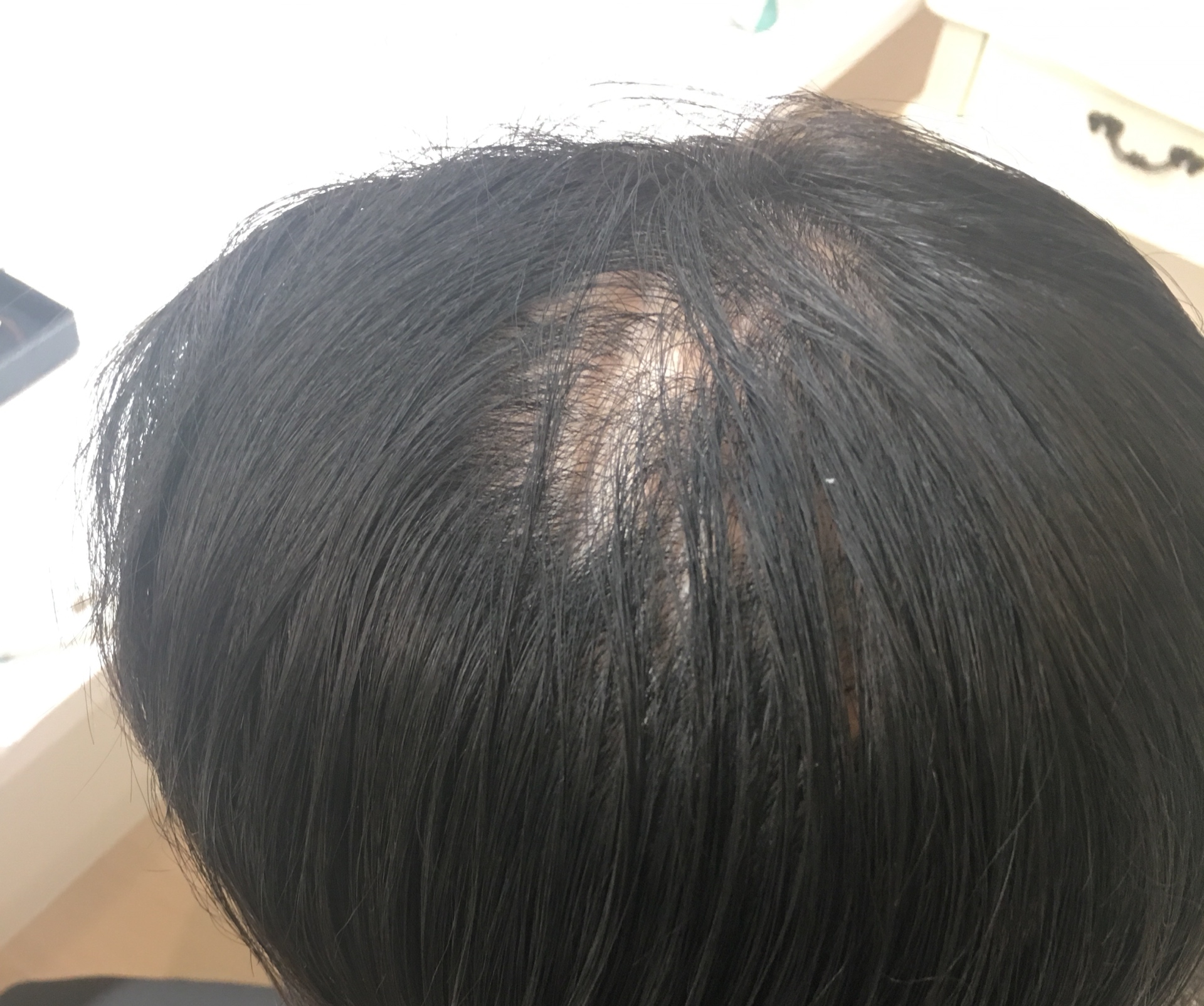 円形脱毛症 ヘアピースで解決｜福岡 北九州